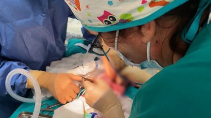 Interviene con éxito un tumor en una bebé que todavía estaba en periodo de gestación