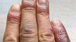 Do your fingers suddenly turn blue? Here's what your body is trying to tell you