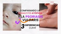 ¿Cómo diferenciar la dermatitis atópica y la psoriasis vulgaris? - #ExclusivoMSP