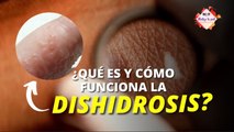 ¿Qué es la #dishidrosis y por qué aparecen ampollas en la piel sin causa alguna? - #ExclusivoMSP