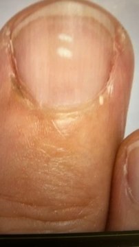 Ces quoi ces petites taches blanches sur les ongles ?