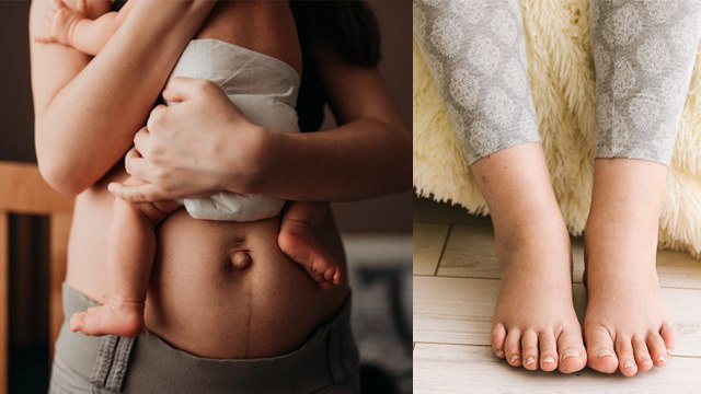 Leg Swelling After Delivery In Hindi: Delivery Ke Bad Pair Me Sujan Kyu Hota Hai | Boldsky