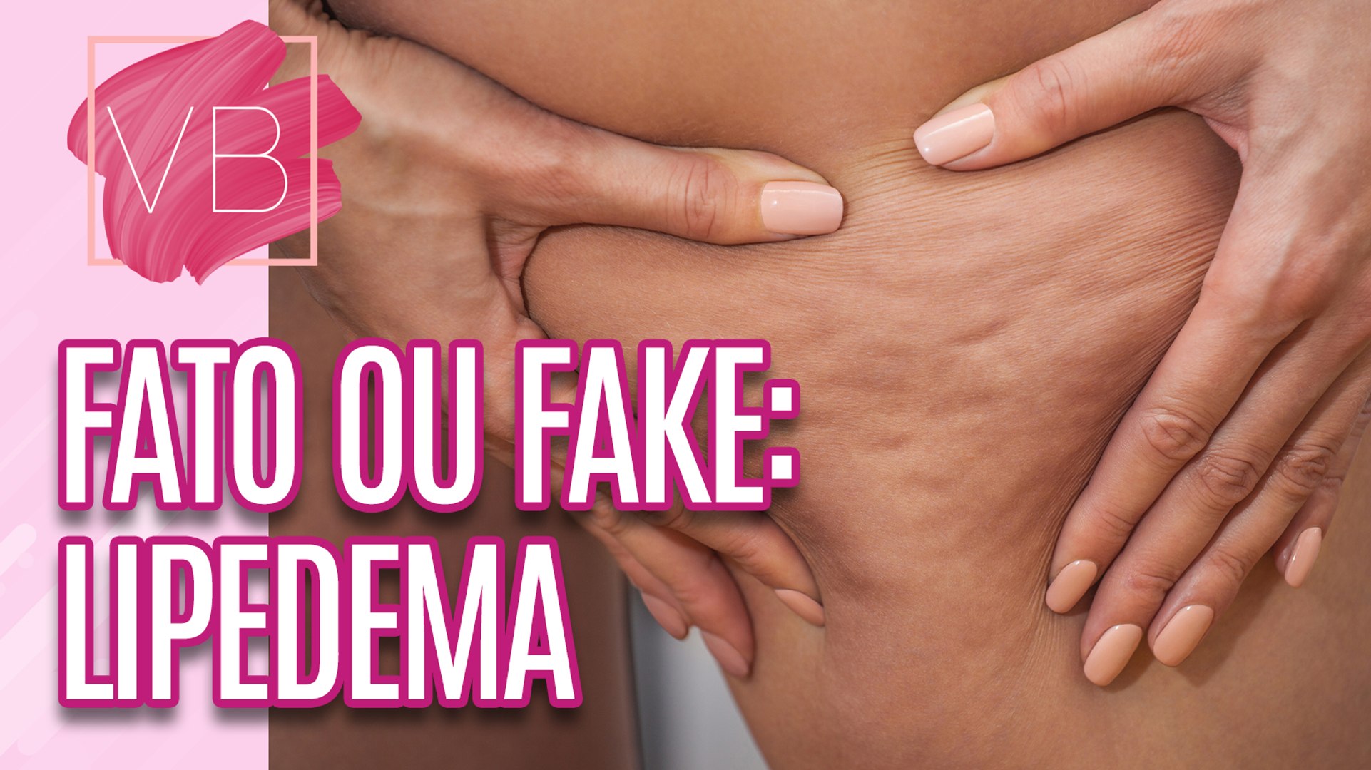 Tudo Sobre Lipedema