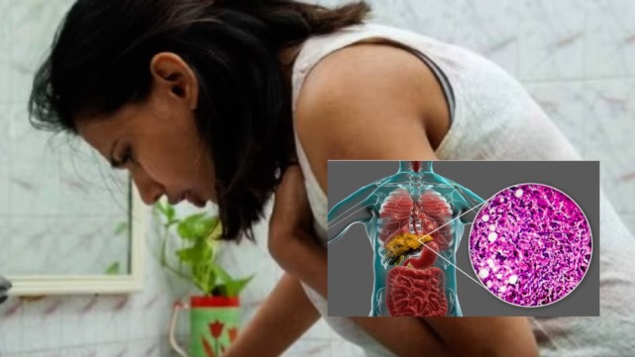 Liver Cirrhosis Symptoms and Life Expectancy: Stage 4 Treatment | लिवर सिरोसिस लास्ट स्टेज लक्षण