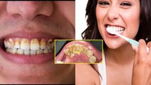 Tartar Teeth Reason In Hindi | दांत में टार्टर बनने का कारण | Boldsky