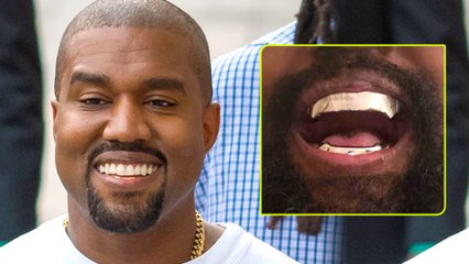 Smile Upgrade: Kanye West Opts for Unique Titanium Dentures Over Traditional Teeth