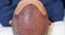 La vacuna que promete curar la alopecia está un poco más cerca y pone en alerta a la industria del trasplante