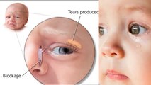 Baby One Eye Watering Reason In Hindi, Treatment क्या है|बच्चे के 1 आंख में पानी आने का कारण|Boldsky