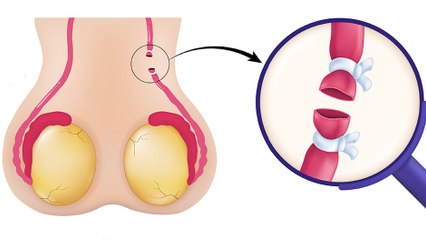 bd-reversion-de-la-vasectomia-230124