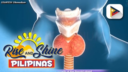 Sanhi at sintomas ng goiter at solusyon dito, alamin!
