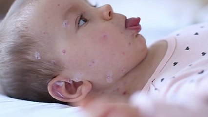 30 fois plus de cas de rougeole en Europe en 2023, selon l'OMS
