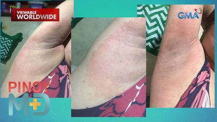 Kilikili ng isang babaeng gumamit ng whitening product, nangitim at nagsugat?! | Pinoy MD