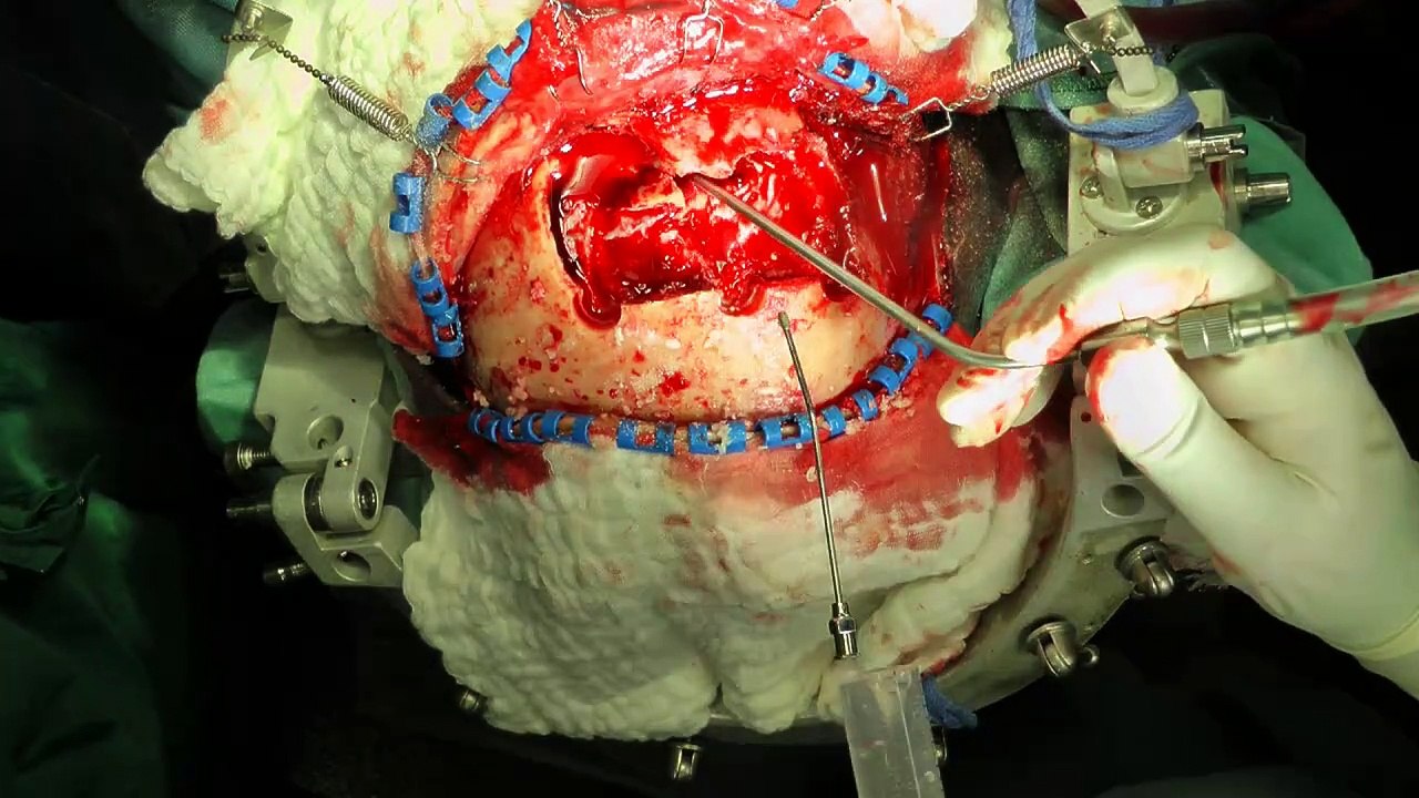 4.1.1 sht, schädelhirntrauma