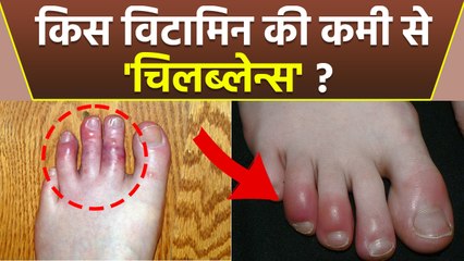 Chilblains किस Vitamin Deficiency से होती है, Winter Finger Swelling Home Remedies