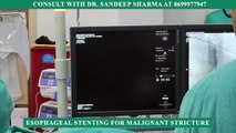 Esophageal Stenting for Malignant Stricture | IRFACILITIES