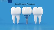 Dental Implants Explained Your Guide to a New Smile