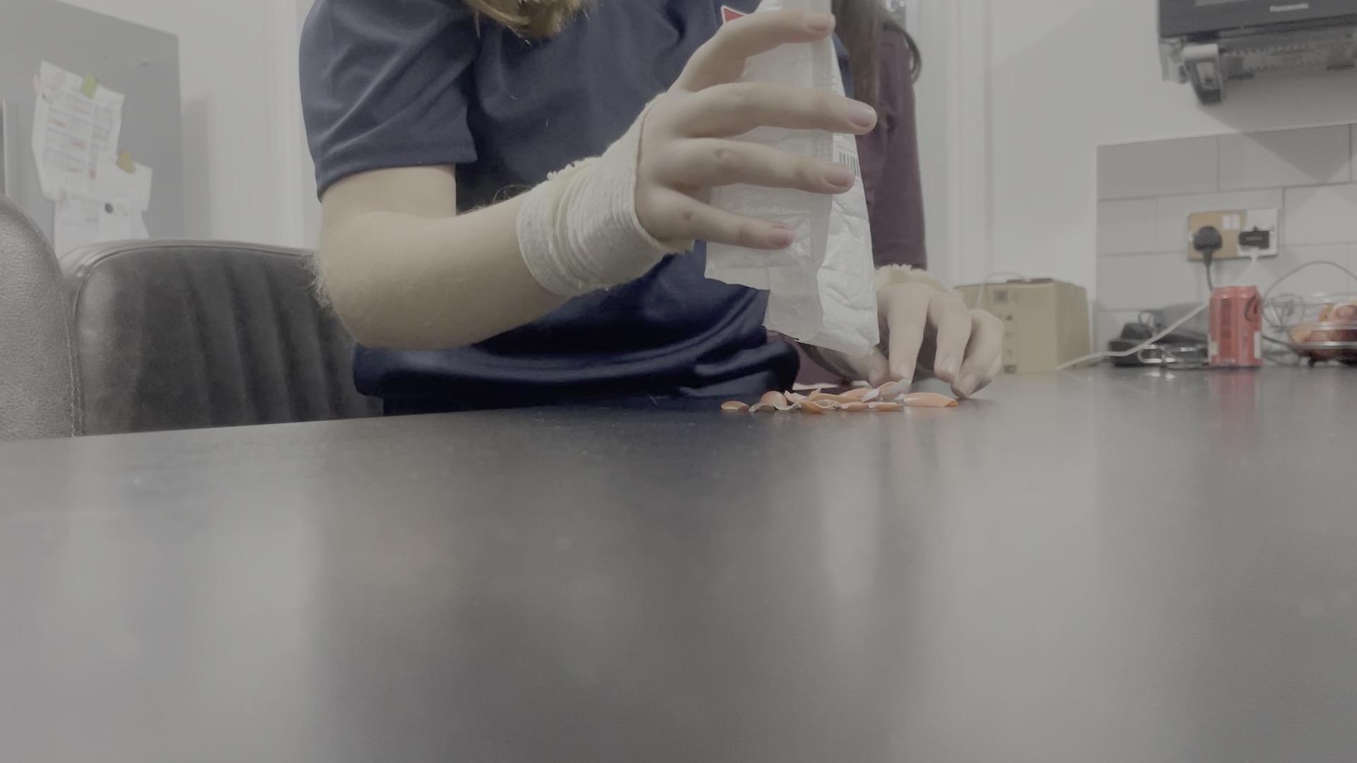 Nail glue leaves young girl with severe burns