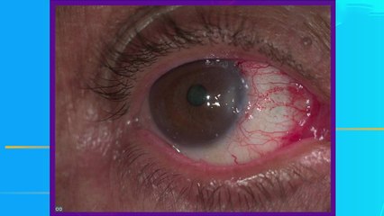 bd-daños-que-provoca-el-sol-en-los-ojos-010224