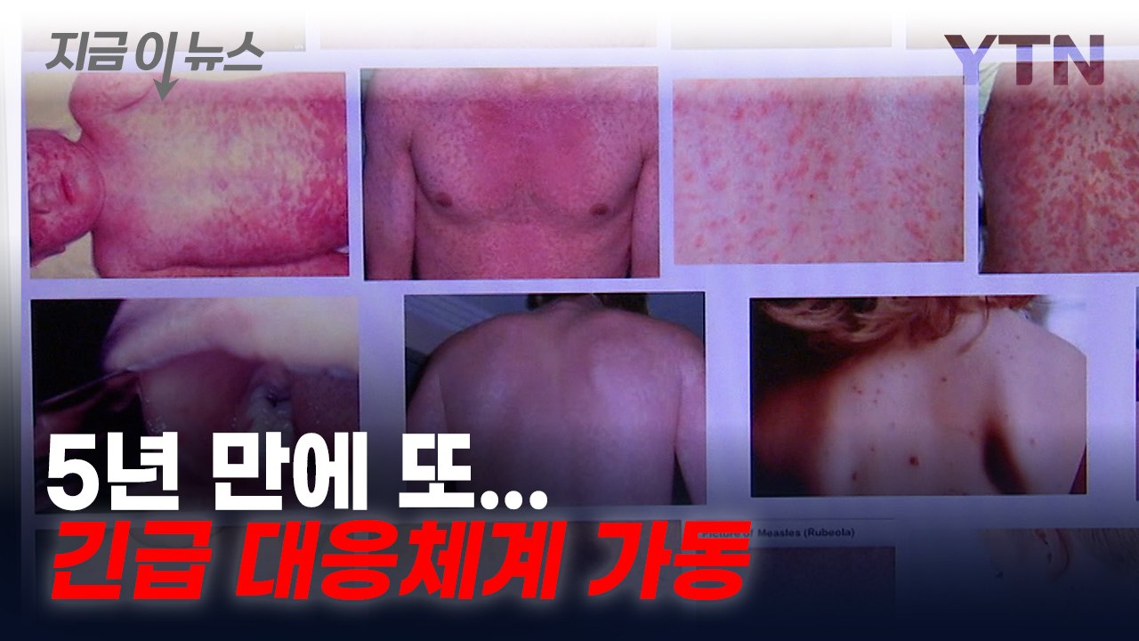 부산서 5년 만에 홍역 환자 1명 발생...확산 방지 총력 [지금이뉴스] / YTN