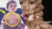 Measles Symptoms In Babies in Hindi | Khasra Ka Ilaj | Baccho Me Khasra Ka Lakshan | Boldsky