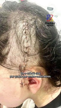 Charlène est atteinte d'une tumeur au cerveau incurable | Speech