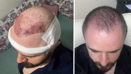 Mahkeme, avukata yapılan saç ekimini ayıplı işlem olarak kabul ederek ücret iadesine karar verdi