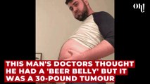 This man's doctors thought he had a 'beer belly' but he actually had a 30-pound tumour