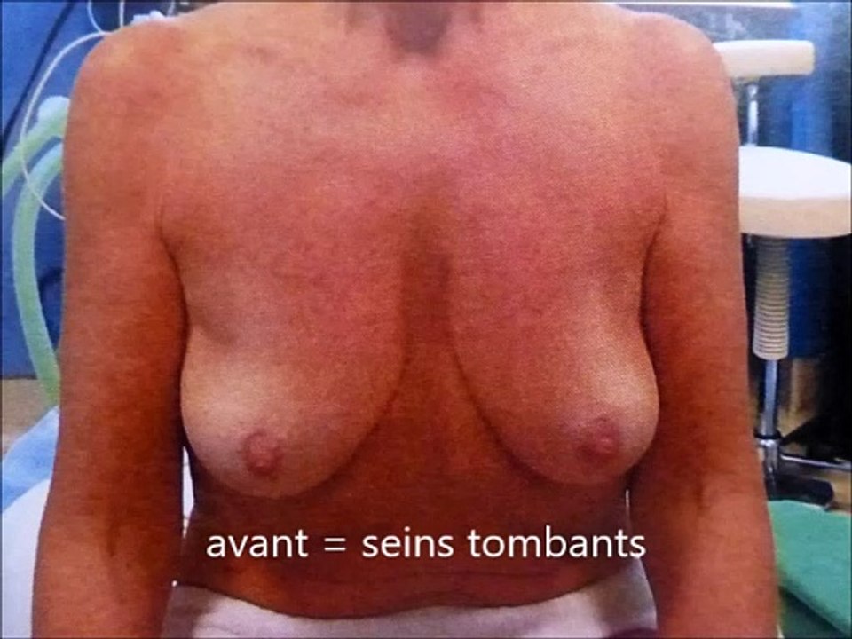 Nouveautés en augmentation mammaire  2024 par vladimir mitz