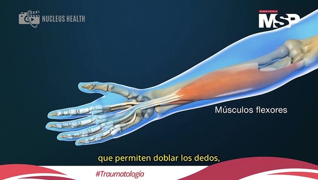 ¿Qué es el dedo en gatillo y por qué es común en mayores de 50 años? - #MSP