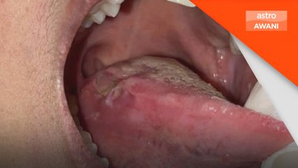 Segera lakukan pemeriksaan jika ada benjolan dalam mulut