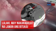 Lalaki, may nakakagulat na laman ang bituka! | GMA Integrated News