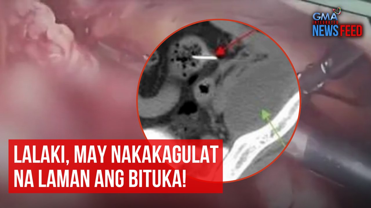 Lalaki, may nakakagulat na laman ang bituka! | GMA Integrated News