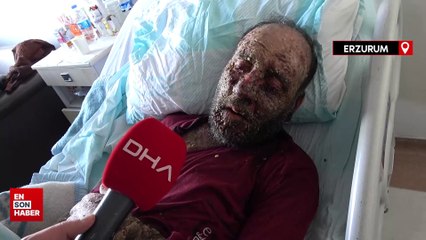 Koronavirüs geçirdikten 1 sene sonra yüzü tanınmaz hale geldi