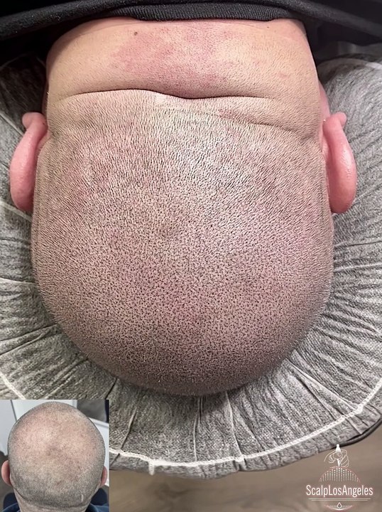 Thinning Crown Restoration