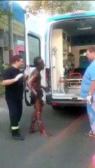 Robacables terminó con el 90% del cuerpo quemado