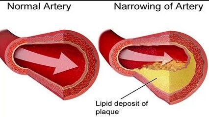 Heart Attacks In The Young