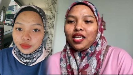 “Dia kata geli” - Wanita dihina rakan sendiri, berhabis RM10,000 tapi jerawat tak juga hilang