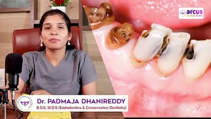 What is Root Canal_ _ Importance of Root Canal _ By Dr Padmaja Reddy _ Arcus Dental Clinic, KPHB