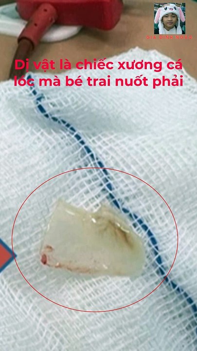 Bé trai 2 tuổi lâm nguy sau khi ăn cháo cá lóc ngày Tết