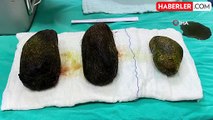 Osmaniye'deki Hastanın Midesinden 2 Kilo Saç Kütlesi Çıkarıldı