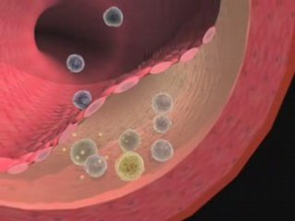 Heart attack-سكتة قلبية-herzkrise-Crise cardiaque