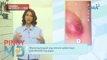 Pabalik-balik na pigsa, paano masosolusyunan? | Pinoy MD