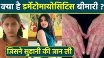 Suhani Bhatnagar Dermatomyositis Disease क्या है | Dermatomyositis Symptoms In Hindi | Boldsky