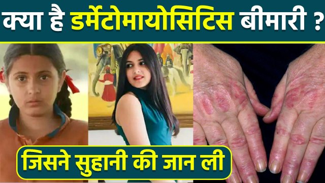 Suhani Bhatnagar Dermatomyositis Disease क्या है | Dermatomyositis Symptoms In Hindi | Boldsky