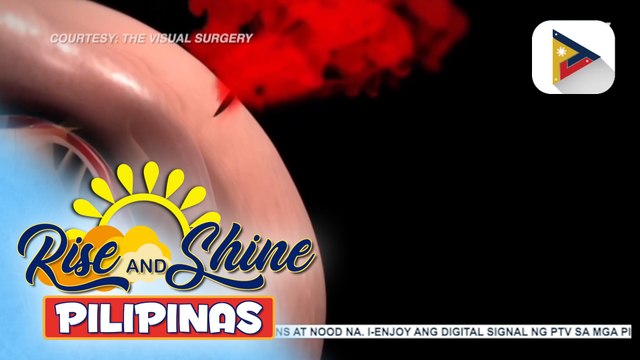 SAY ni DOK | Ano ang aneurysm, ano ang sanhi, sintomas at paano ito ginagamot