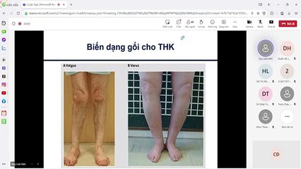 Thoái hóa khớp - Thầy Mai Duy Linh