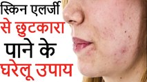 स्किन एलर्जी से छुटकारा पाने के घरेलू उपाय | Skin Allergy Treatment And Diagnosis