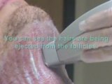 Laser Facial Hair Removal on Neck