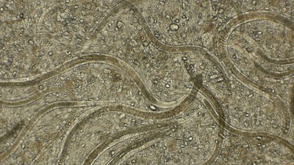 This girl died after suffering from persistent headaches