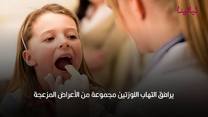 علاج التهاب اللوزتين